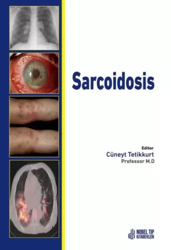 Sarcoidosis