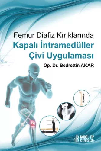 Femur Diafiz Kırıklarında Kapalı İntramedüller Çivi Uygulaması